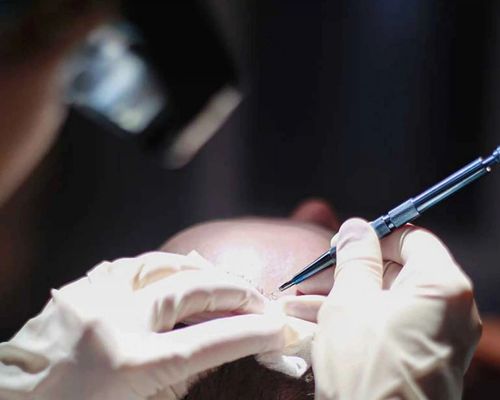 Does implanter FUE give more natural results?