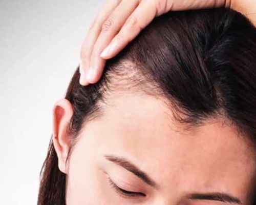 Hair transplant for women: what are the options?