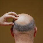 baldness still be treated