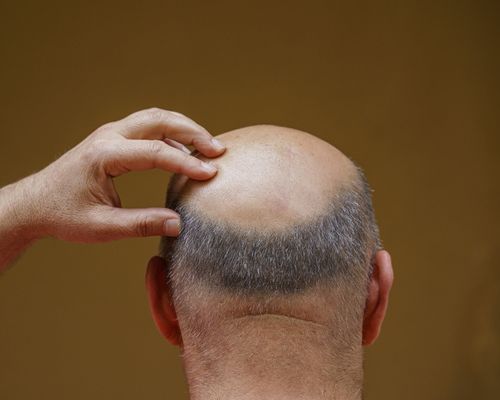 baldness still be treated