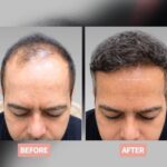 Hair Transplant look natural