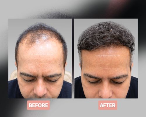 Hair Transplant look natural