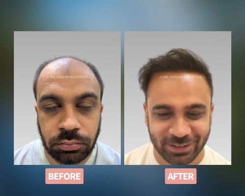 What makes a hair transplant look natural?