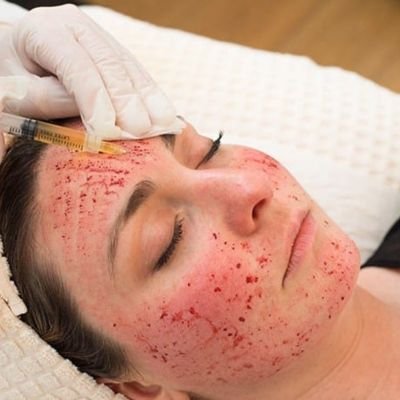 PRP Rejuvenation Facial