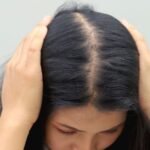 hair loss in women