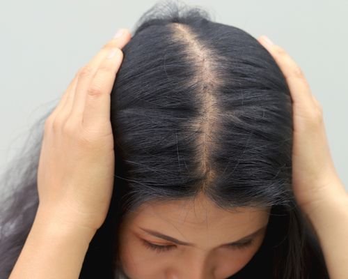 What causes hair loss in women?