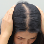 Female pattern hair loss: Signs and treatment