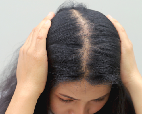 Female pattern hair loss: Early signs, causes and treatment options