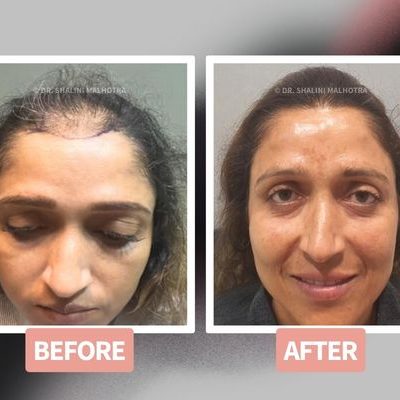 Women hair transplant