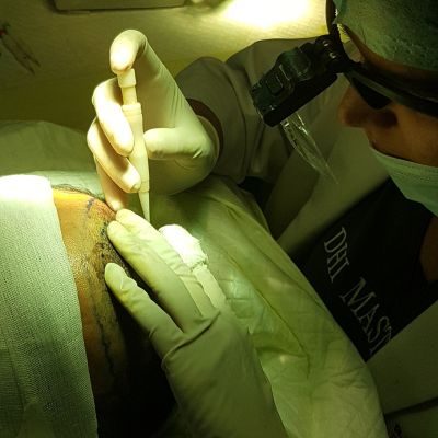 advanced fue hair transplant