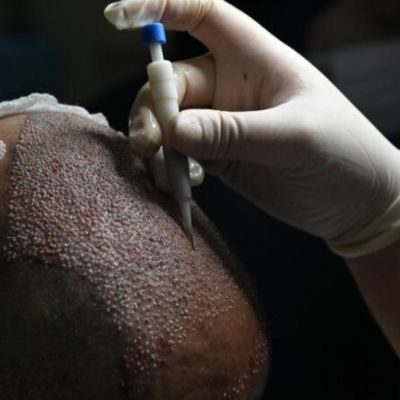 hair transplant implanter